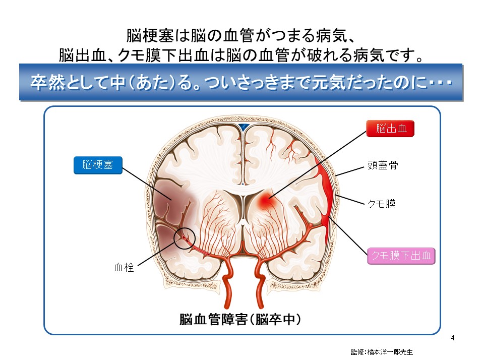 脳卒中について のむらニューロスリープクリニック 内科 神経内科 睡眠障害外来